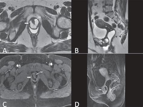 glande skene|Skene’s Gland: Function, Location, Secretion & Conditions